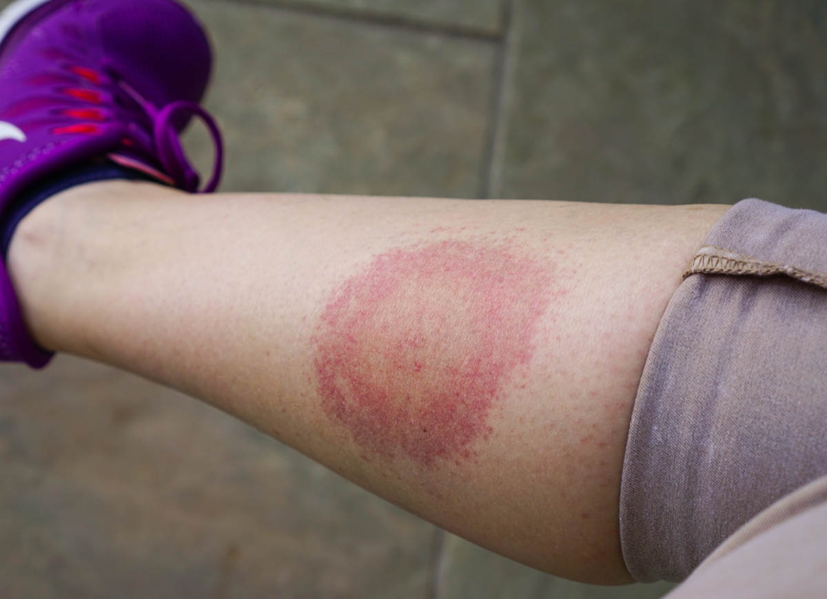 person with lyme disease
